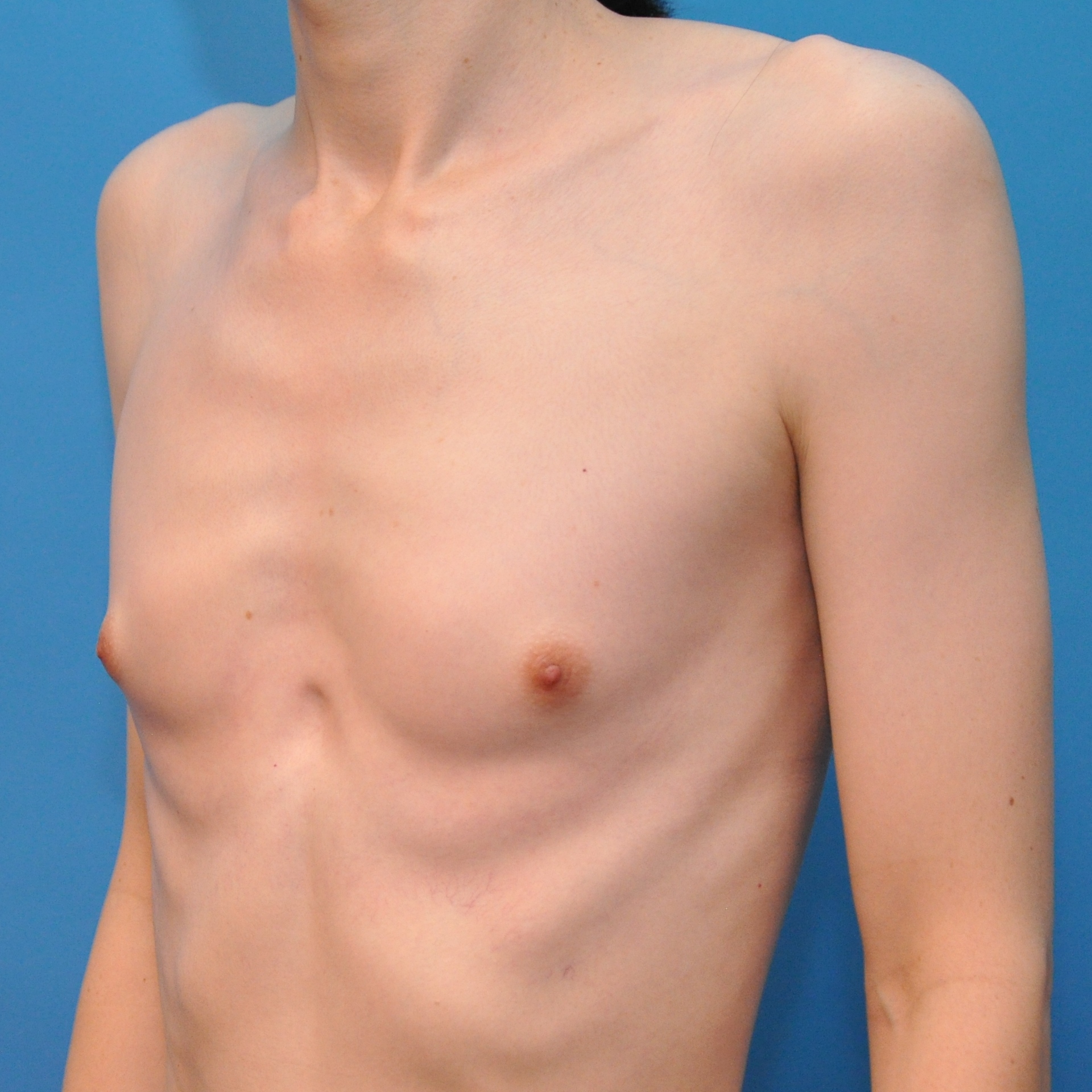 Breast Augmentation Transsexual 111