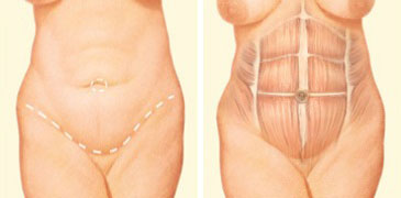 tummy-tuck-incision-front-abdomen.jpg