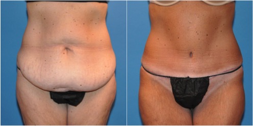 composite-before-and-after.jpg