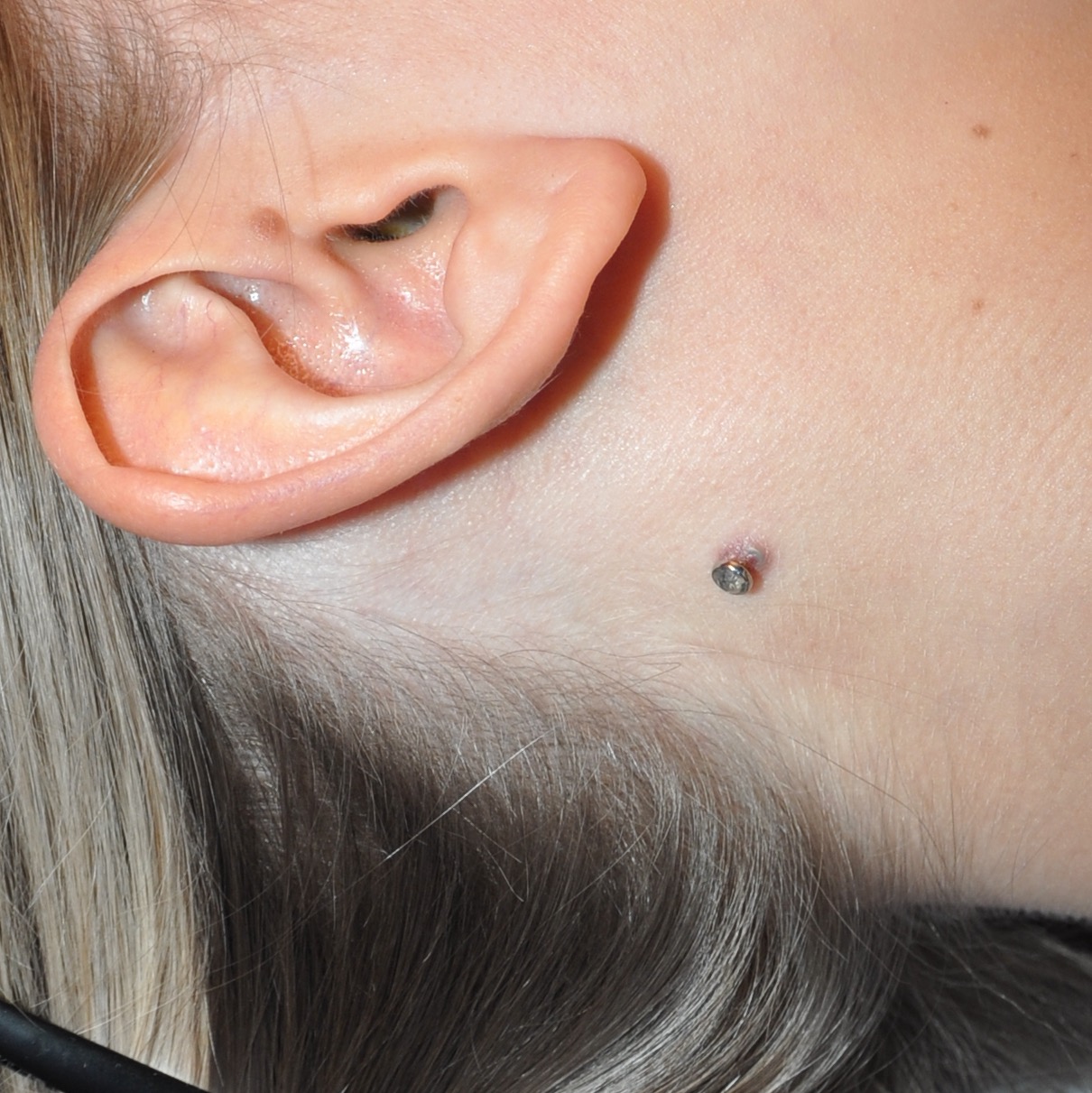 afschaffen halfgeleider Politie Dermal Piercing Removed from Neck and Wrist by a Plastic Surgeon | Dr.  Cooper