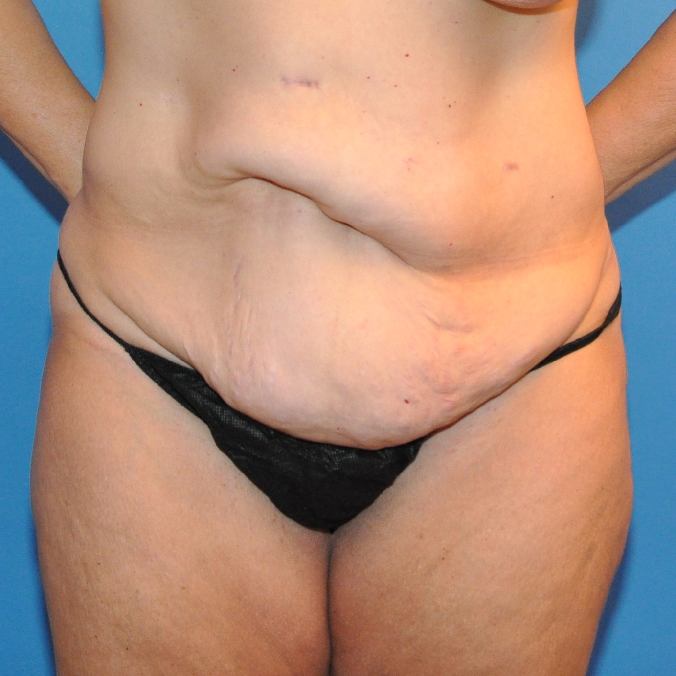 pre-op-cropped-abdomen-anterior.jpg